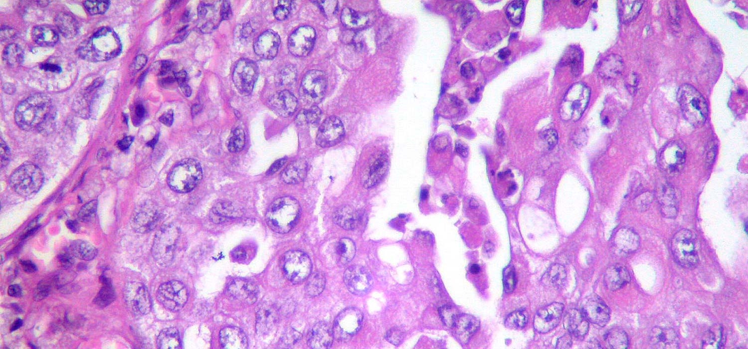 Carcinoma de células transicionales